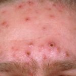 Parents warned about chickenpox outbreak in schools