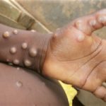 Health ministry corrects fake news about Mpox cases